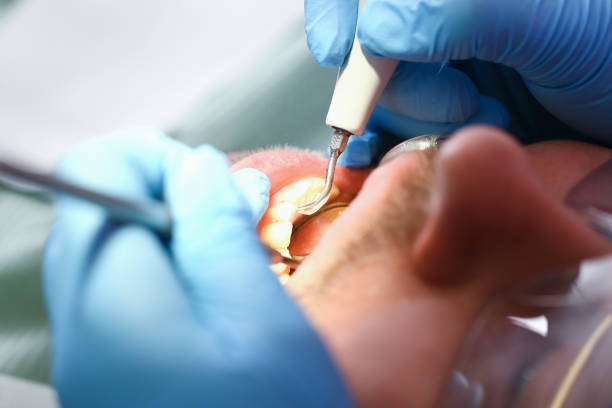 Best Emergency Root Canal Treatment in Bel Nor, MO