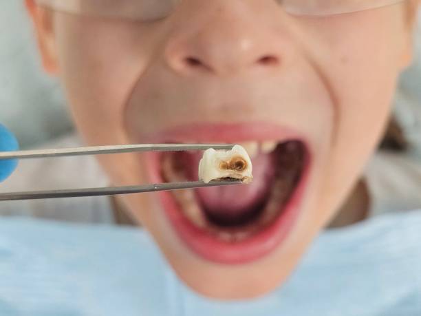 Best Emergency Dentist for Knocked-Out Tooth in Bel Nor, MO